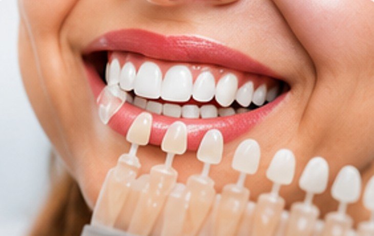 Cosmetic dental shade selection